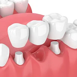 Dental bridge