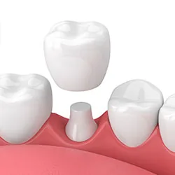 Dental crown