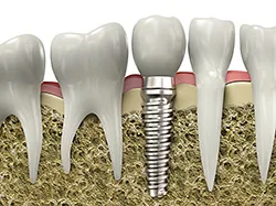 Dental implant model