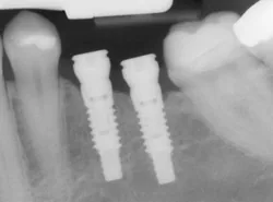 X-ray of a dental implant