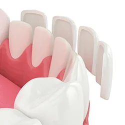 Porcelain veneers