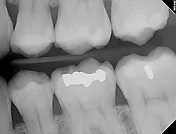 Digital dental X-ray